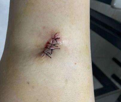 伤口的图片,图解伤口愈合全貌