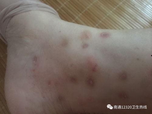 手上长虫子图片大全