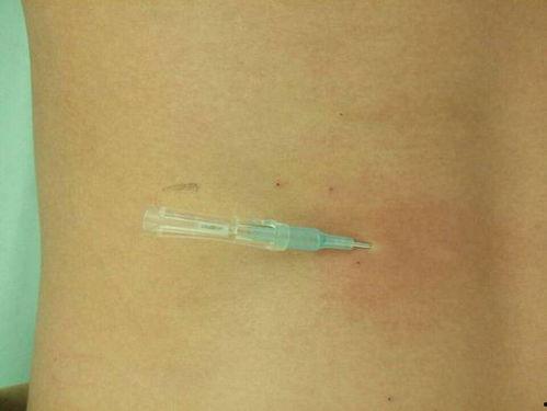 浮针图片,揭秘现代针灸的神奇疗效