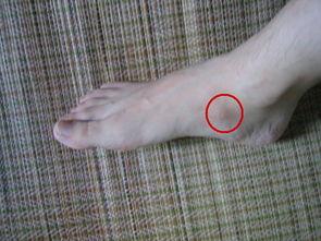 副舟骨突出的图片,解剖结构解析与临床特征