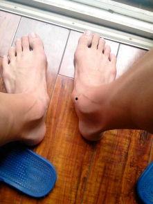 副舟骨突出的图片,解剖结构解析与临床特征